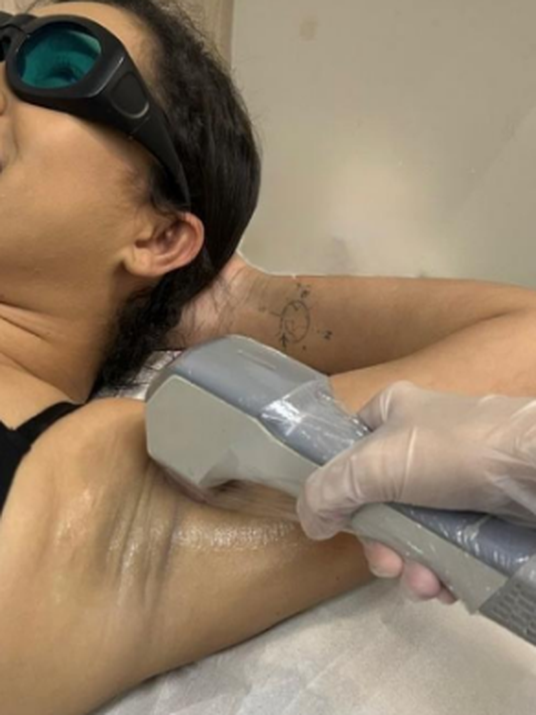 Depilação a Laser